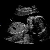 2d ultrasound